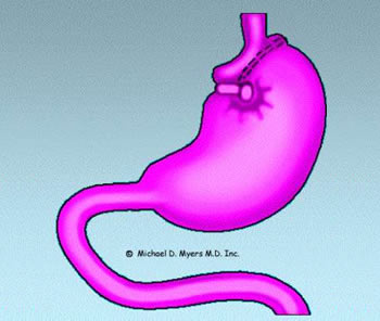 image of the stomach demonstrating how it is modified for a vertical banded gastroplasty